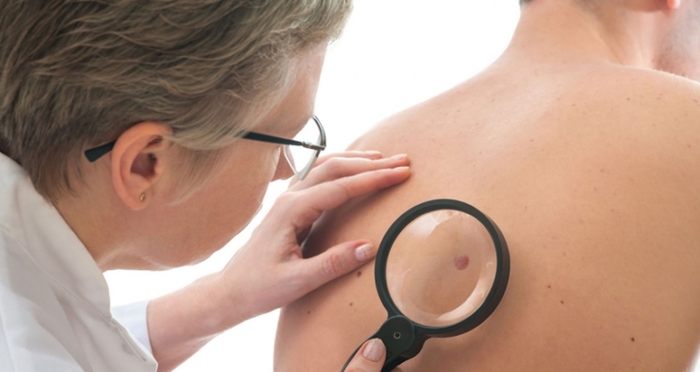 Mole Removal